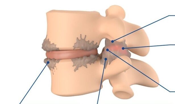 Modifications tissulaires dans la spondylarthrose