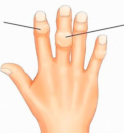 Noeuds de Heberden et Bouchard au niveau des articulations interphalangiennes avec arthrose