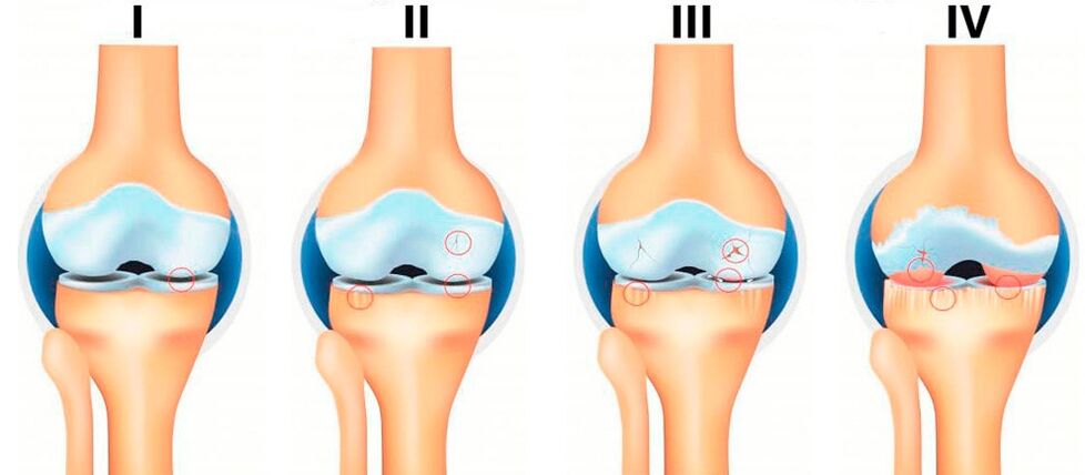 Stades de l'arthrose
