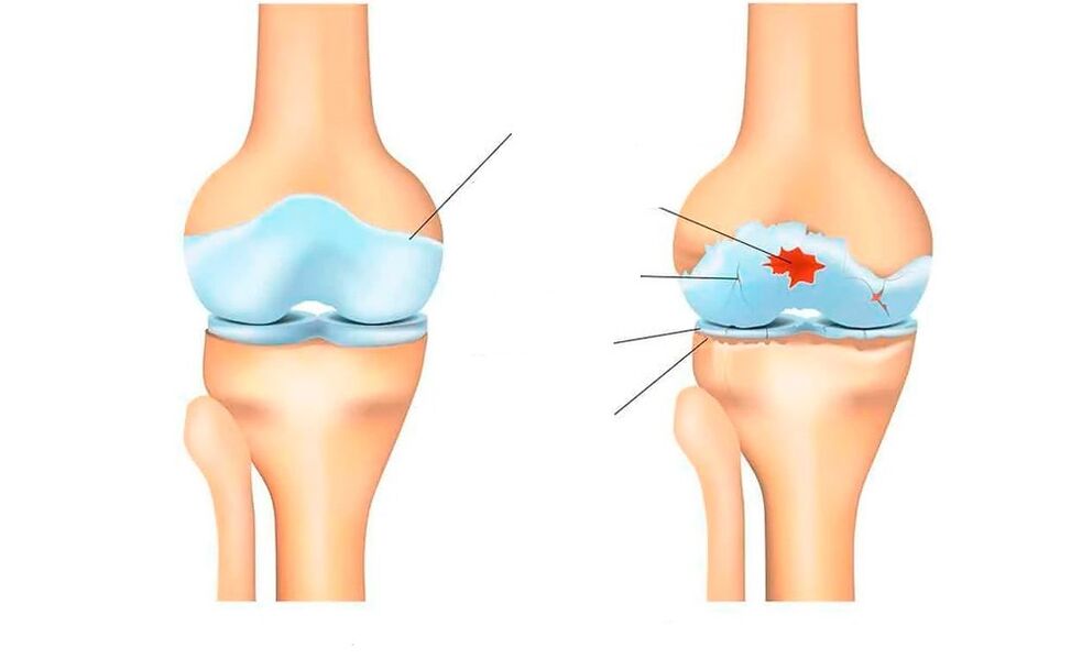 articulation saine et pour l'arthrose