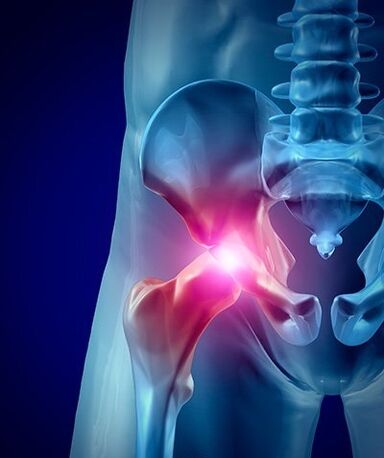 Douleur à la hanche photo 1