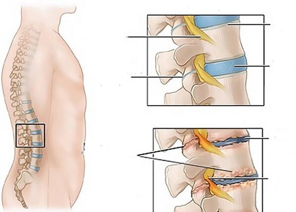 Modifications des disques intervertébraux dues à l'ostéochondrose