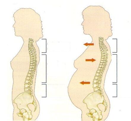Ostéochondrose pendant la grossesse