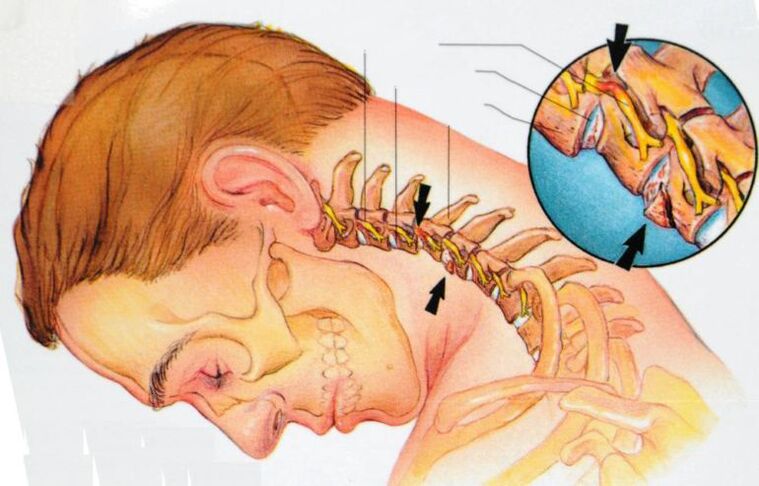 Symptômes de l'ostéochondrose cervicale